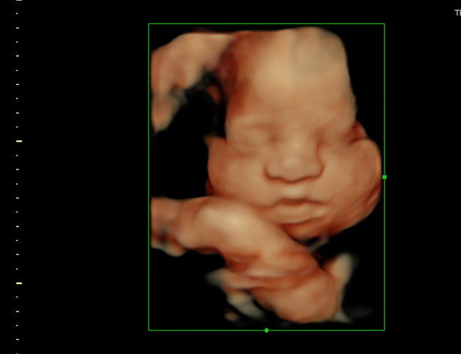 3D ultrasound image at 29 weeks